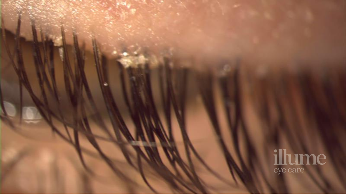 Waking Up with Crusty, Red Eyes? It Might Be Blepharitis (And Here’s How to Fix It)
