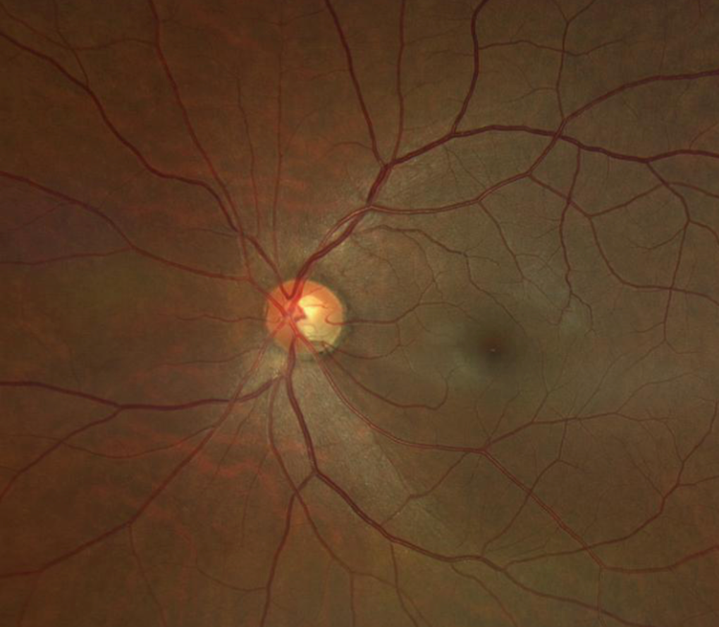 Glaucoma Awareness Month - Glaucoma and Lifestyle: What You Should Know
