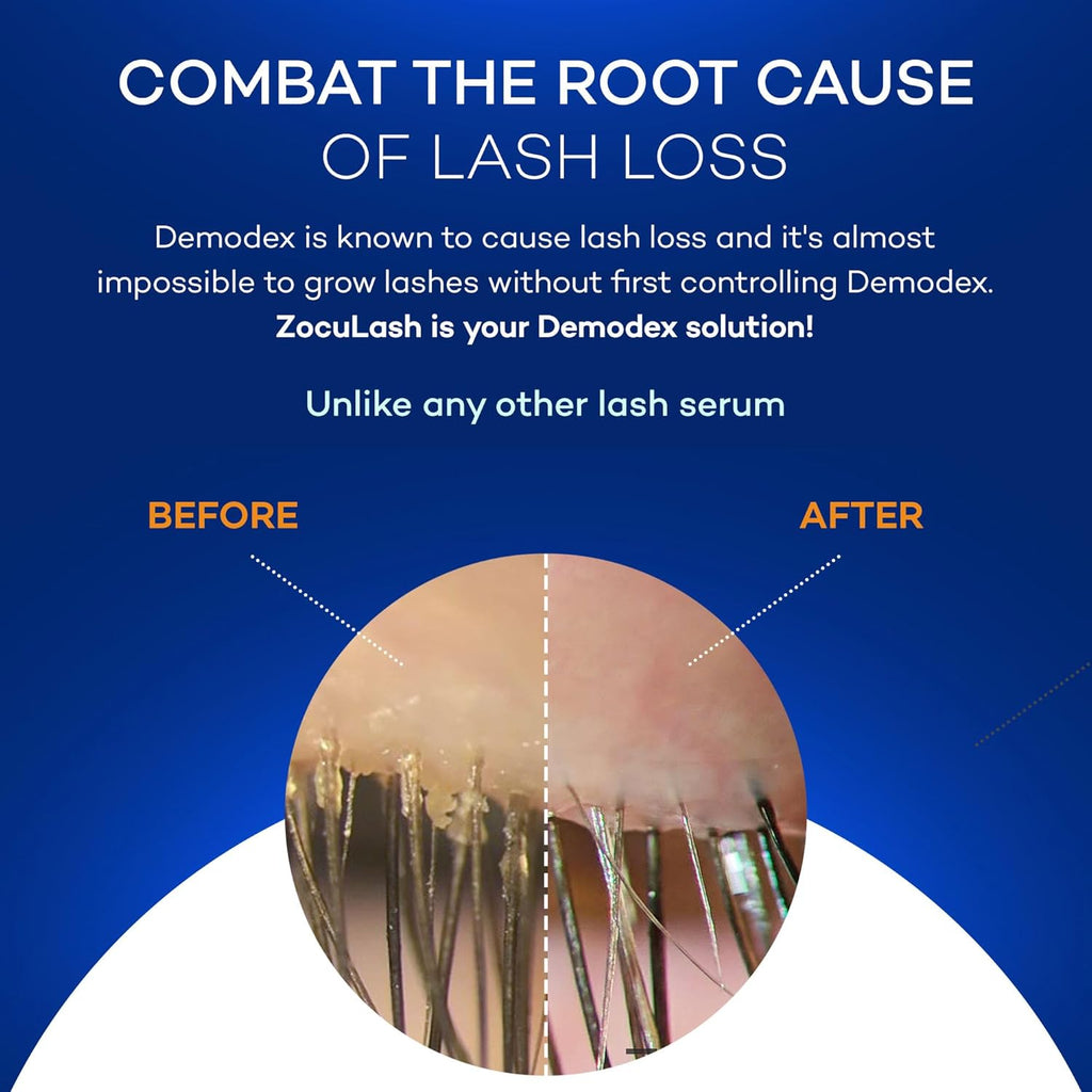 Lash Demodex Mites Blephartiis Zocular